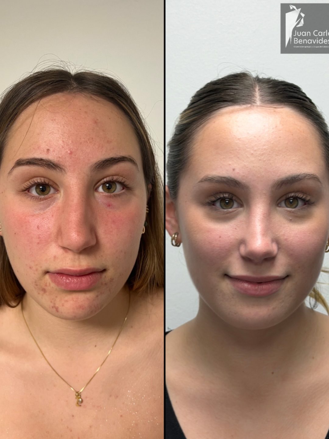 Antes y después de frente de una rinoplastia, control a 2 años