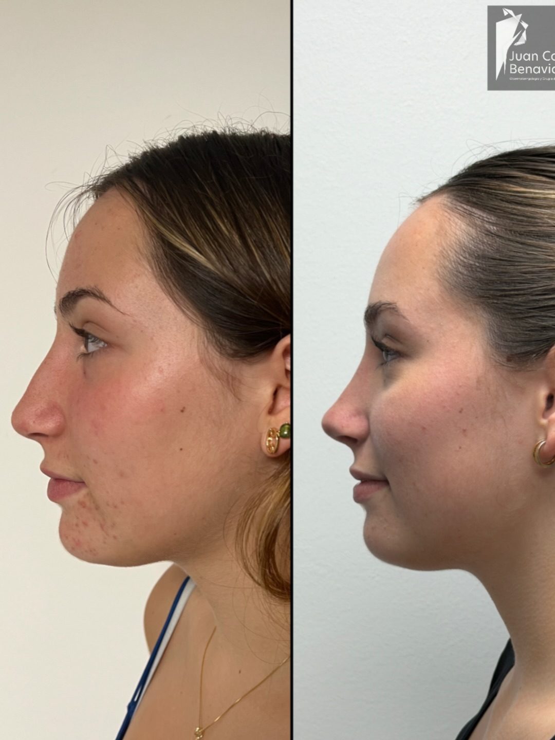 Antes y después de perfil de una rinoplastia, control a 2 años