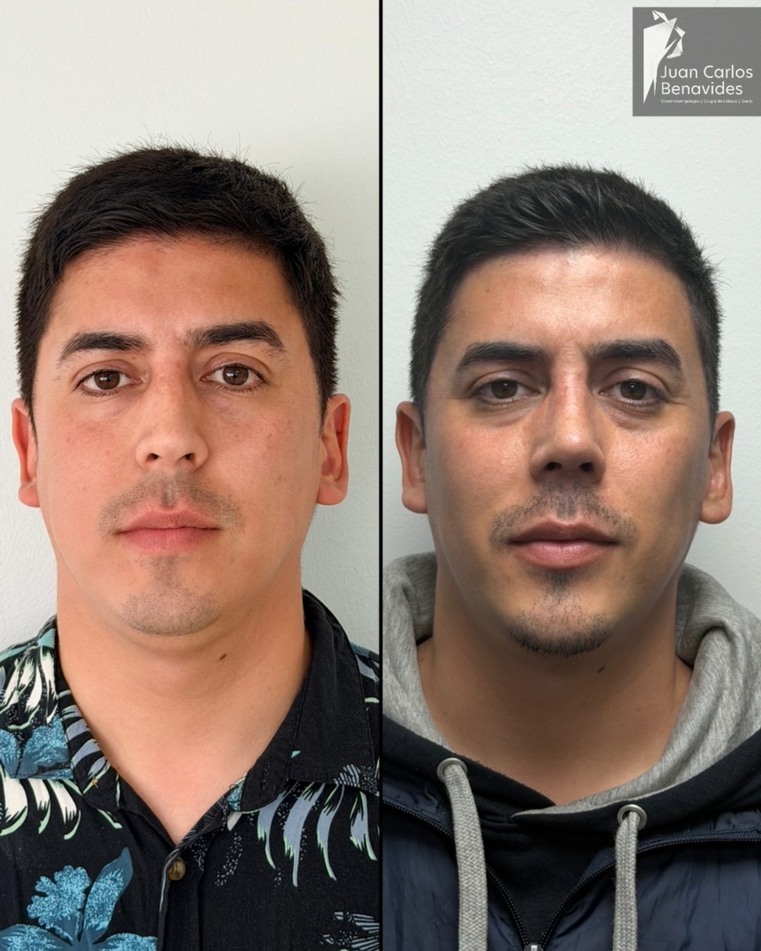 Antes y después de frente de un paciente con rinoplastia ultrasónica y mentoplastia, 5 semanas
