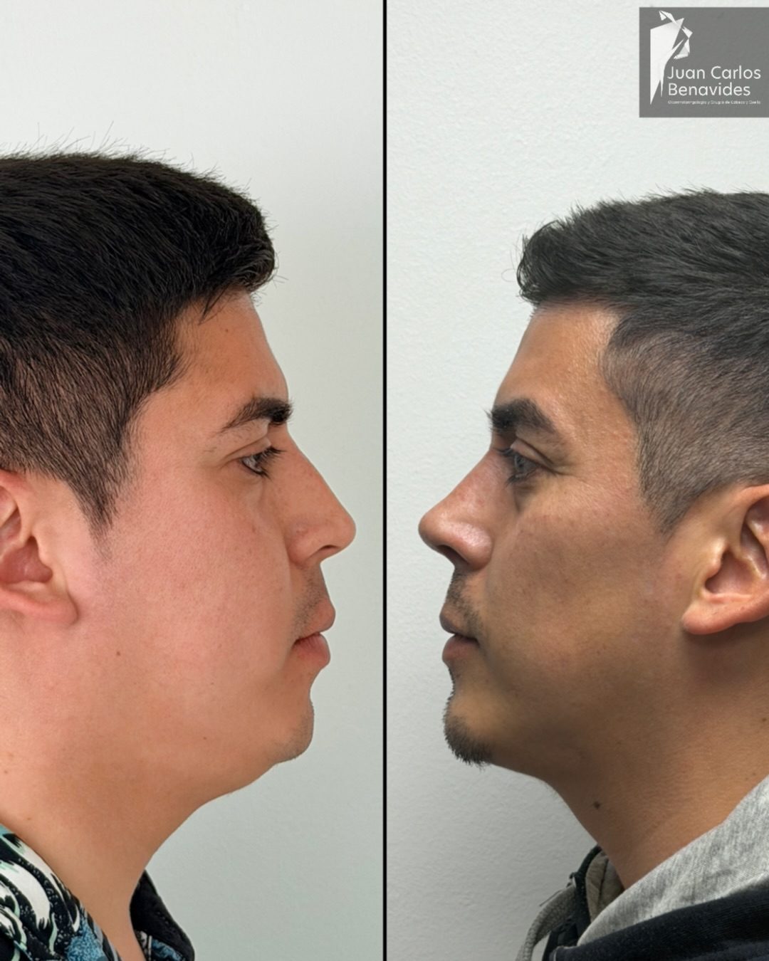 Antes y después de perfil de un paciente con rinoplastia ultrasónica y mentoplastia, 5 semanas