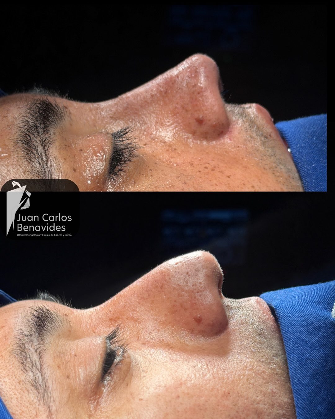 Comparativo intraoperatorio de rinoplastia masculina en nariz mestiza