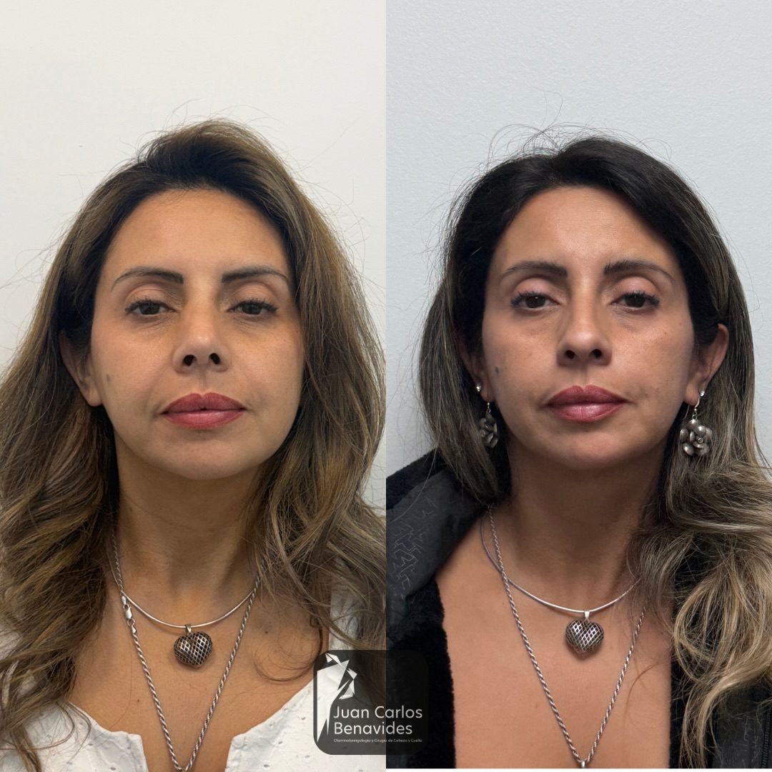 Antes y después de frente de una paciente con rinoplastia ultrasónica, control a 2 meses