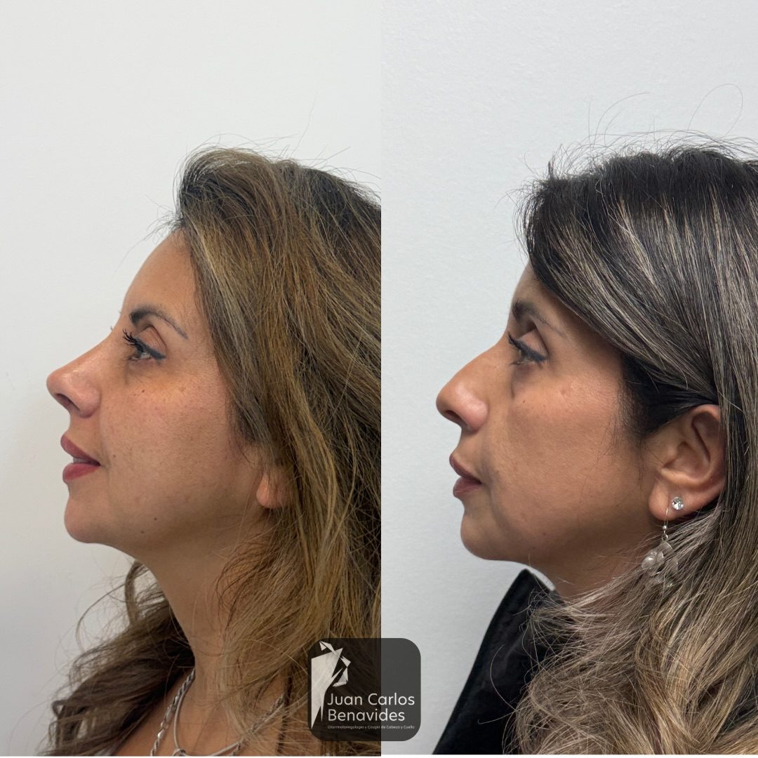 Antes y después de perfil de una paciente con rinoplastia ultrasónica, control a 2 meses