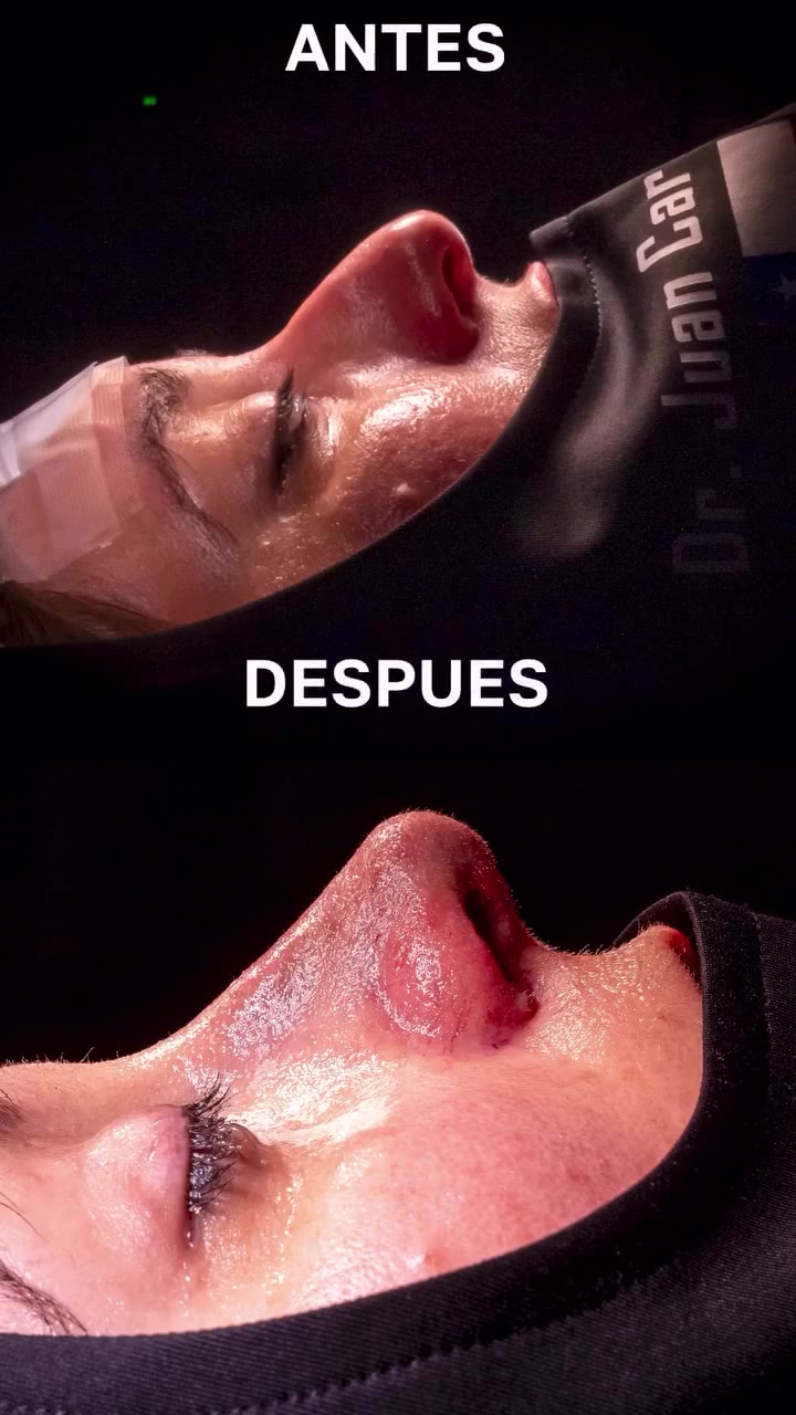 El doctor explica una rinoplastia ultrasónica